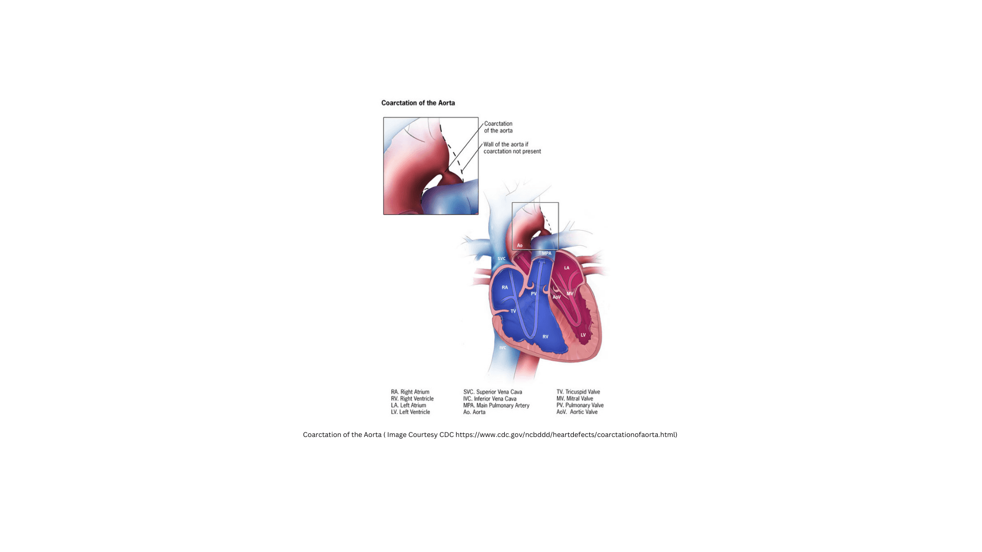 Coarctation of the Aorta (CoA)