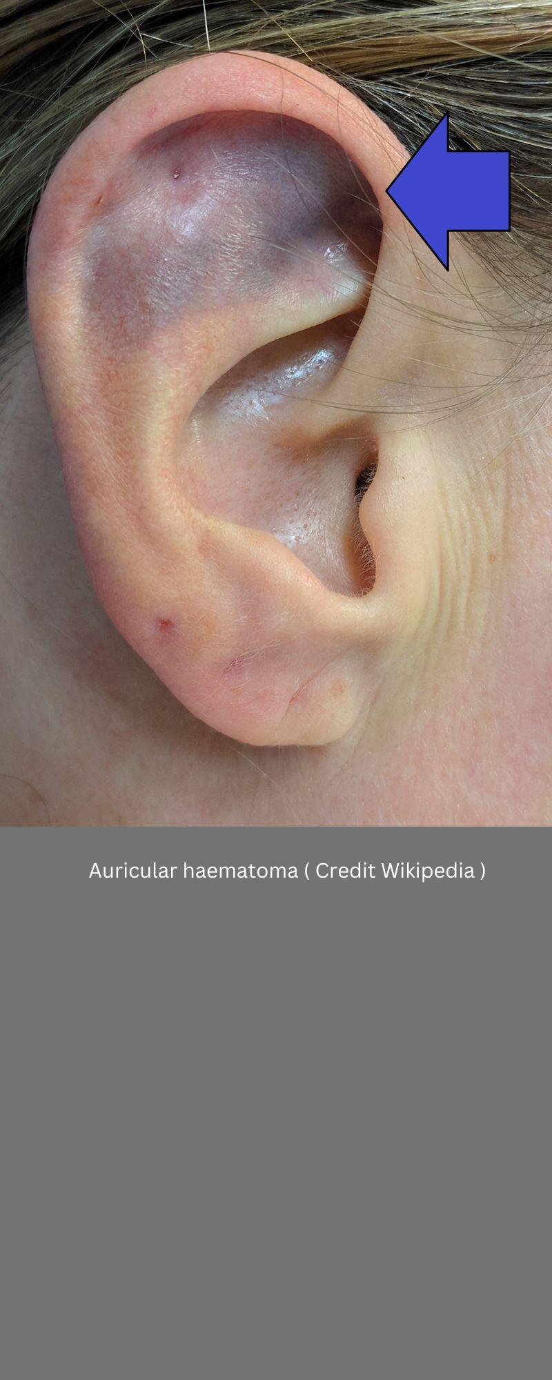 Auricular haematoma ( Cauliflower ear )