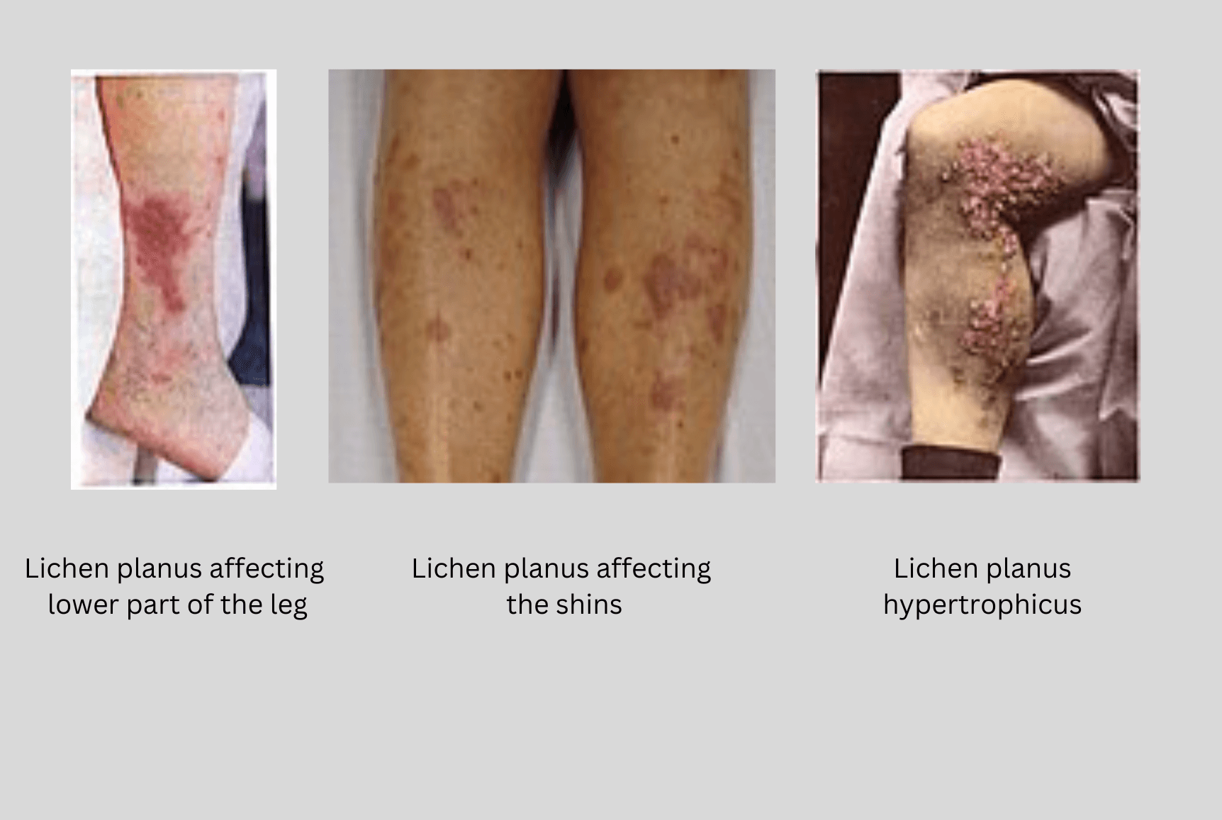 Lichen planus