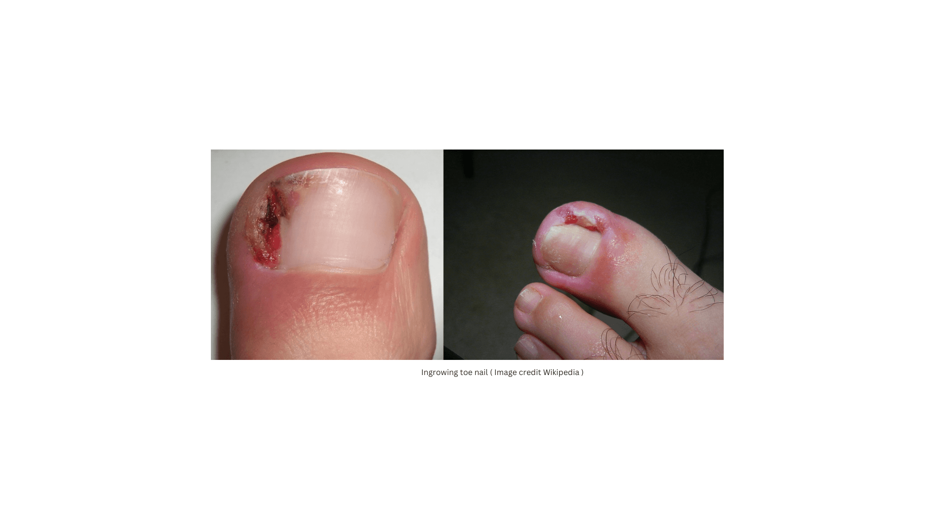 Ingrowing toe nail ( onychocryptosis )